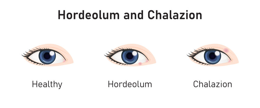 Hordeolum and Chalazion Concept Design. Vector Illustration.