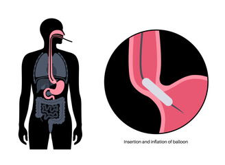 Obraz premium Endoscopic pneumatic dilation