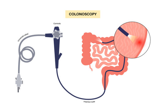 Colonoscopy medical procedure
