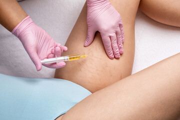 The beautician makes injections of blood plasma on the thighs of a woman.  Treatment of skin stretch marks in the clinic.