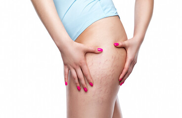 A woman after weight loss shows stretch marks on the skin of her legs and the outer and inner side...