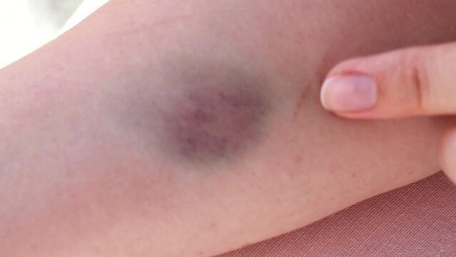 The young woman is inspecting a  violet contusion on her skin, located on her arm. It resulted from a sports-related injury. The girl examines a large purple bruise on the skin.