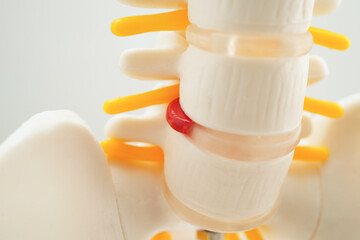 Spinal nerve and bone, Lumbar spine displaced herniated disc fragment, Model for treatment medical...