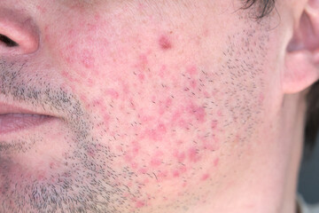 Dermatitis on man face. Eczema close up.