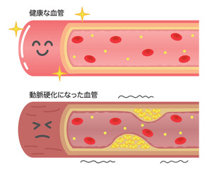 健康な血管と動脈硬化で狭窄した血管の比較イラスト