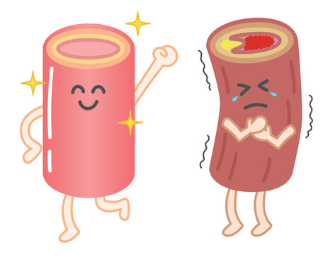 健康な血管と動脈硬化で閉塞した血管の表情付きイラスト