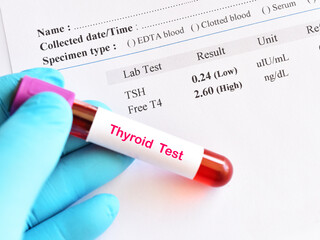 Blood sample tube with abnormal thyroid hormone test result - obrazy, fototapety, plakaty