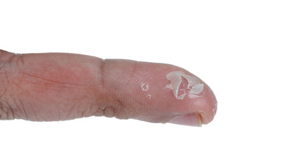 Eczema Dermatitis of Fingers isolate on white