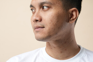 Obraz premium Profile of Asian young man with problem skin, isolated on a cream background.