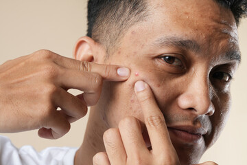 Obraz premium Photo of an Asian man with problematic skin. Acne and red pimples on the face of a young man. Skin care concept and isolated on beige background.