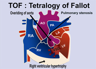 The picture show the structure of tetralogy of fallot that show the 4 part defect of heart which is overriding of aorta , pulmonary stenosis  ,VSD, right ventricular hypertrophy for medical concept