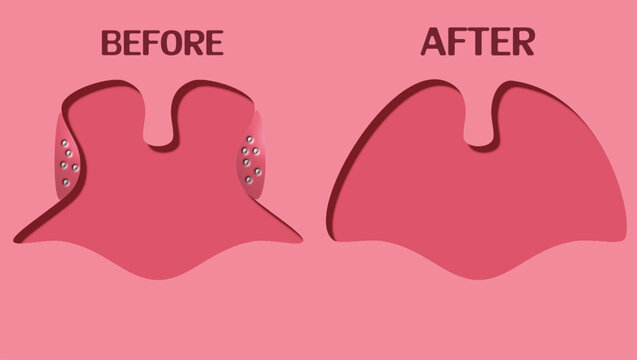 Tonsil surgery before and after, Tonsillectomy