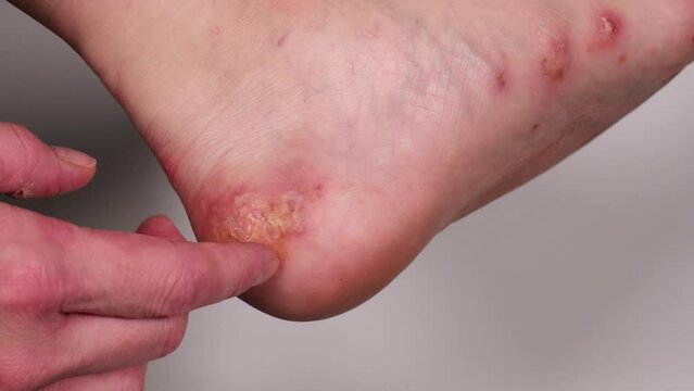 Woman scratching her heel with her finger or nail and peeling of some old skin pieces. Huge wound on female foot after several confluent blisters of eczema. Acute psoriasis, allergic reaction on foot.