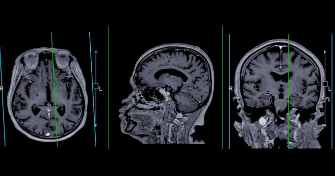 MRI Brain with reference line can help doctors look for conditions such as bleeding, swelling, tumors, infections, inflammation, damage from an injury or a stroke diseases.