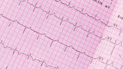 Heartbeat healthcare and medicine, pulse rate red grid paper that shows sinus rhythm abnormality of right ventricular hypertrophy. Cardiac fibrillation. Vital sign. Medical healthcare symbol.