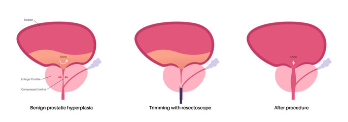 Transurethral resection of the prostate - obrazy, fototapety, plakaty