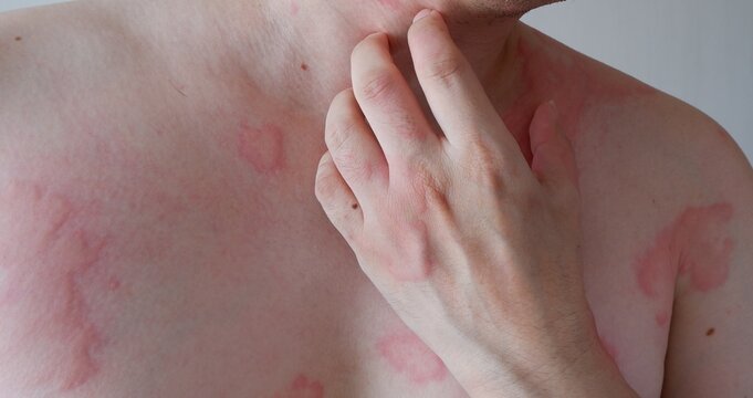 Close up image of skin texture suffering severe urticaria or hives or kaligata. Allergy symptoms.