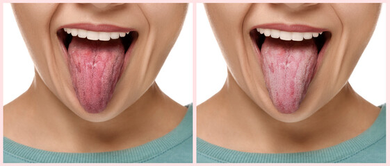 Collage with photos of woman before and after tongue cleaning on white background, closeup