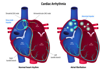 Cardiac Arrhythmia vector. Compare the differences between normal heart rhythm and atrial fibrillation. A heart arrhythmia is an irregular heartbeat.