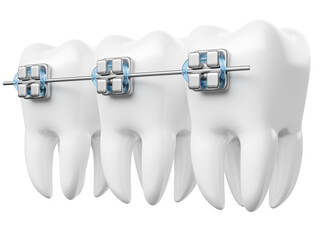 Realistic teeth with dental braces in on transparent background in 3d render 