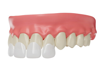 Realistic teeth with lenses and gums in on transparent background in 3d render 