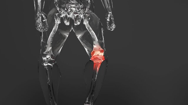Pain in the arthritic knee joint, Knee painful, skeleton x-ray, arthritis, osteoarthritis. Meniscus, Tendon problems and Joint inflammation, trauma, rheumatologist, anatomy and medicine, 3d render
