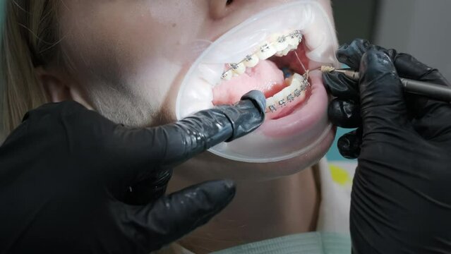 Close up of dentist hand using dental forceps while putting orthodontic braces on female patient teeth. Woman having dental procedure in clinic. Concept of dentistry and orthodontic treatment.