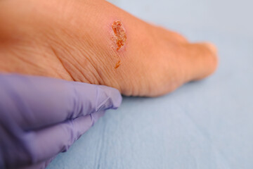 doctor treats weeping wound, trophic ulcer on female leg, wound exudate prevents healing ulcers by...