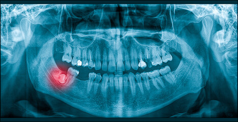 Growing Wisdom Toothache On X-Ray