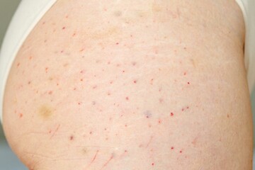 Carbon dioxide therapy, carboxytherapy complications, bruis . Skin rejuvenation, treatment of joint pain.The procedure is performed on hip joint of woman patient. Close up