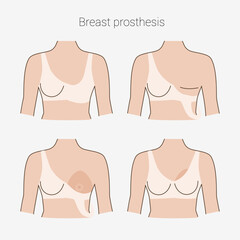 Woman after mastectomy. A girl without breasts tries on a breast prosthesis. Breast cancer. Vector illustration.
