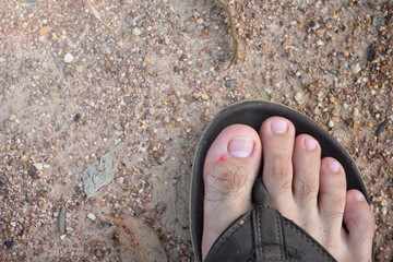 Wounds on the feet close up on earthy background with soft sunlight, feet in sandals,scar on foot,dermatitis.