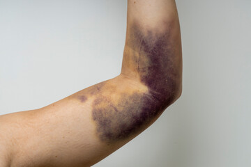 Arm with a major bruise.