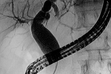 Pancreatography image of upper gastroenterology endoscopy. Medical themes - obrazy, fototapety, plakaty