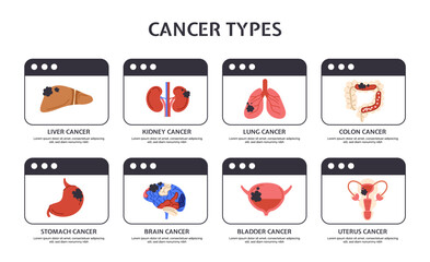 Types of cancer concept. Medical infographics and educational materials. Internal organs, biology and anatomy. Poster or banner. Cartoon flat vector illustration isolated on white background