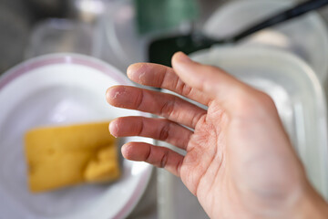 Hand with peeling skin because of dish washing