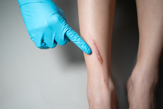 Woman leg blistered and red skin from accidental scalds.