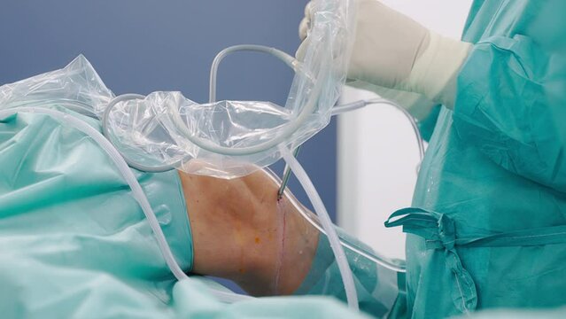 Professional Surgeon Performing Arthroscopic Knee Surgery - close up side view. Doctor Uses Arthroscope to See With Micro Camera Inside Joint and Irrigating or Trimming Instruments to Repair Tissues