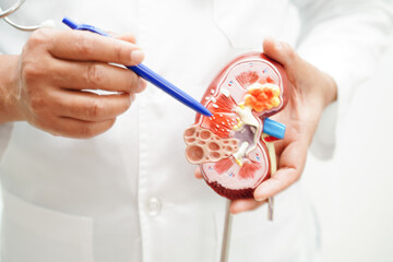 Chronic kidney disease, doctor holding model for treatment urinary system, urology, Estimated...