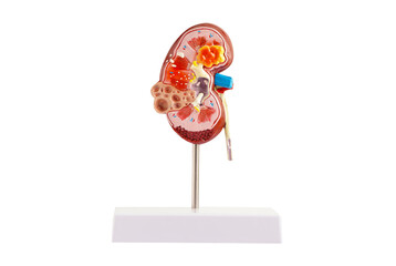 Kidney model isolated on white background with clipping path. Chronic kidney disease, treatment...