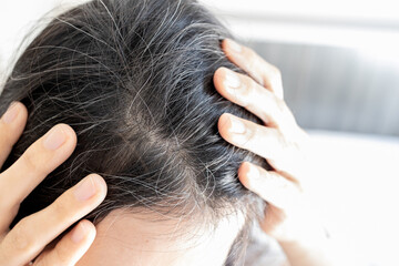 Premature gray hair problem,stressed asian young woman with hair loss,thyroid or autoimmune...