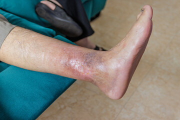 Leg senior person with ulcer due to diabetes - obrazy, fototapety, plakaty