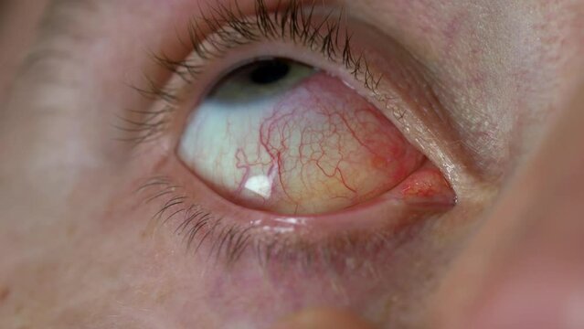 Dropping Eye Drops into Bloodshot Eyes Caused by Ophthalmia Inflammation