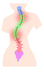 側湾症の背骨のシンプルなイラスト