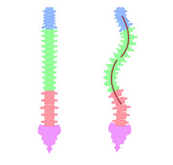 側湾症の背骨のシンプルなイラスト