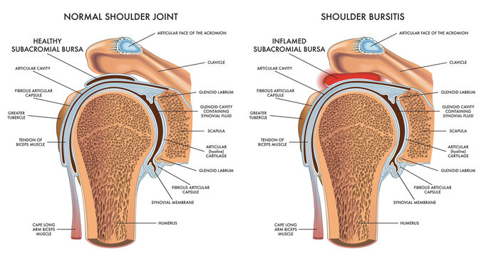 Medical illustration comparing a normal shoulder to a shoulder bursitis, with annotations.