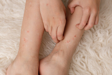 Child's legs and hands with many red spot, from insect bite, mosquitos and fleas