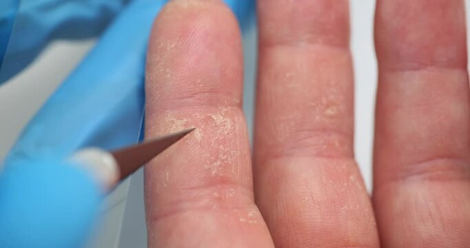 Doctor scrapes skin with tweezers for analysis closeup. Male fingers with psoriasis and eczema