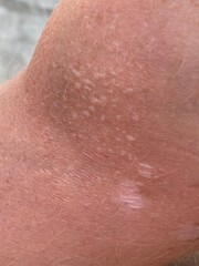 Close up on blistered skin damaged by sun exposure.