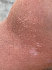 Fototapeta premium Close up on blistered skin damaged by sun exposure.